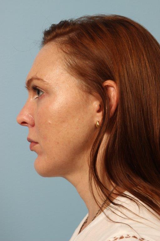Chin Augmentation Before and After 02